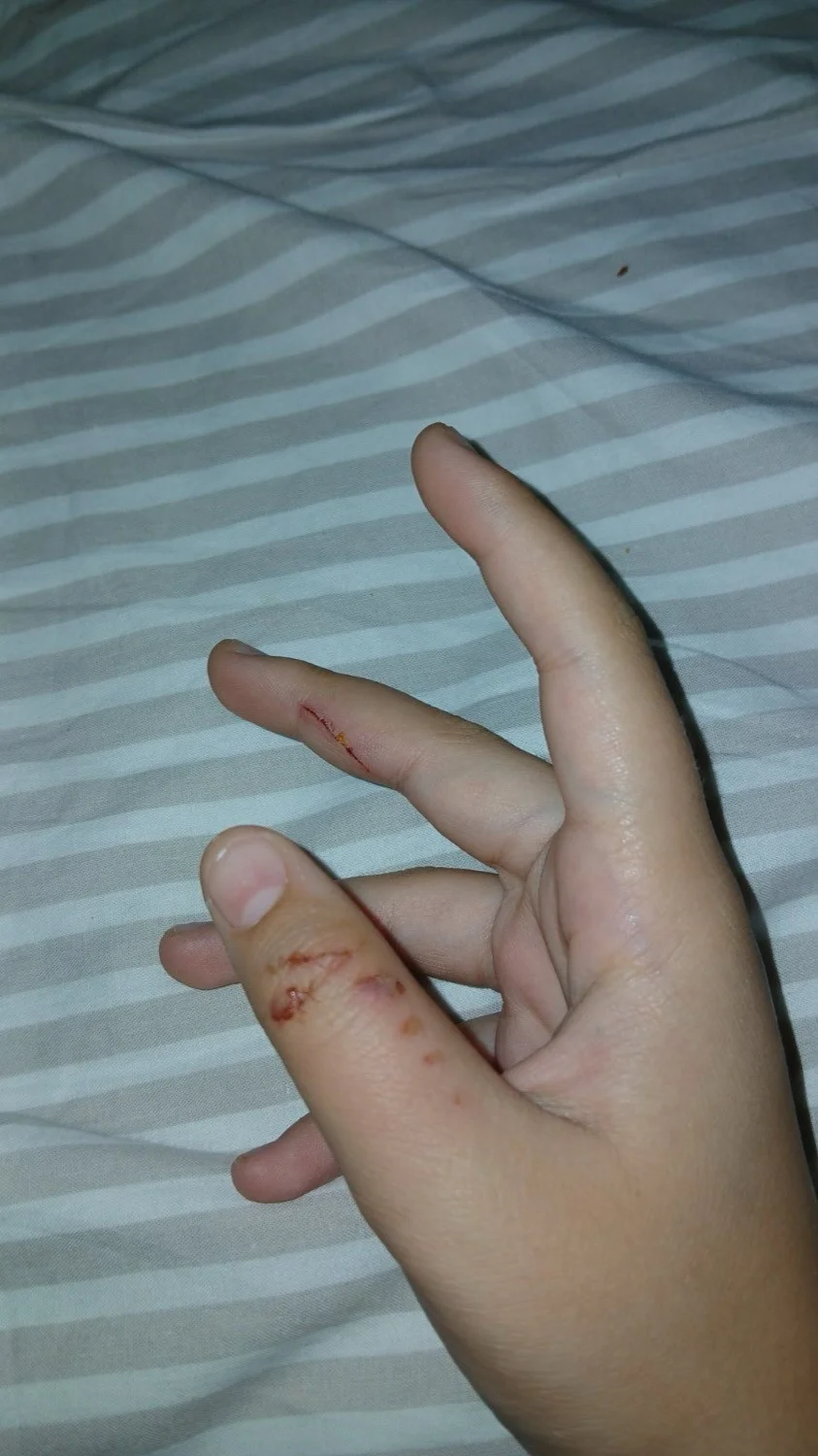 Το χέρι της 12χρονης, μετά το δάγκωμα από τον αδέσποτο σκύλο / Φωτογραφία: onlarissa