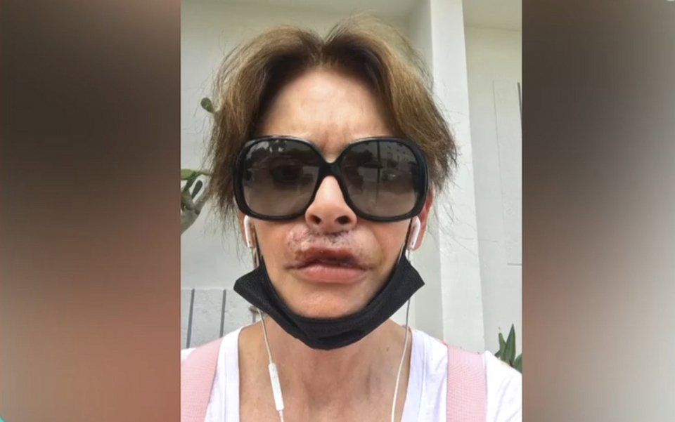 Η Κατερίνα Πλουμιδάκη λίγο καιρό μετά την επέμβαση