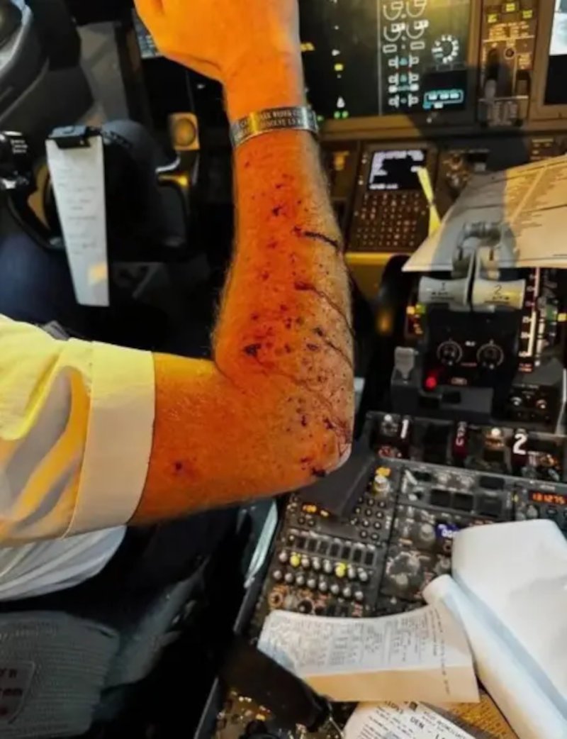 Το τραυματισμένο χέρι του πιλότου του Boeing