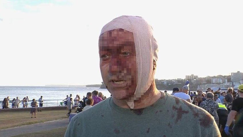 O Αρσέν Οστρόφσκι,  επιζών της επίθεσης της Χαμάς στο φεστιβάλ Nova στις 7 Οκτωβρίου του 2023, τραυματίστηκε στο μακελειό στο Bondi Beach