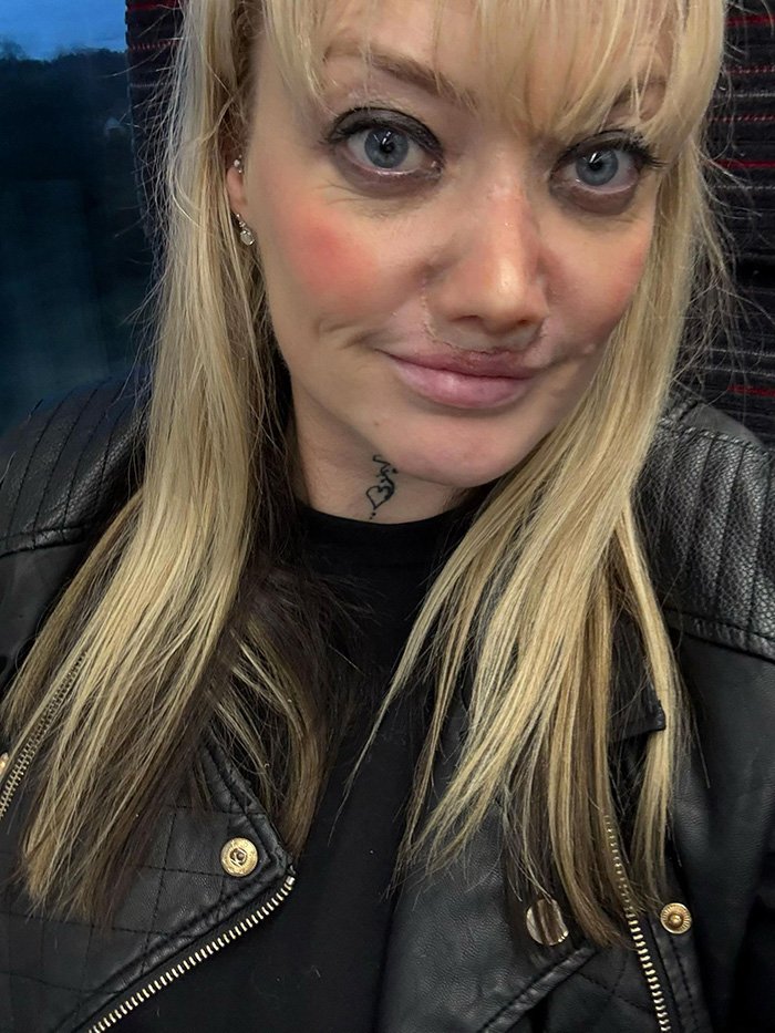 Η Βρετανίδα με τη νέα της μύτη 