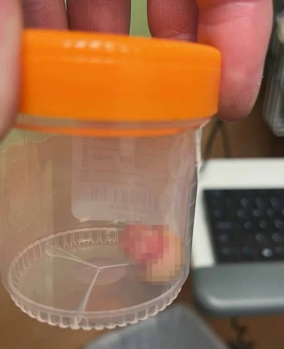 Το φερόμενο ως κομμένο δάχτυλο του αστυνομικού