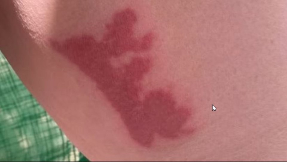 Ένα από τα εγκαύματα που υπέστη η Ντεζίν Έλιοτ από τον καφέ που χύθηκε