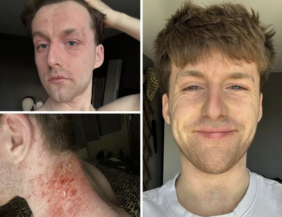 O 22χρονος Henry Jones περιγράφει τη μετάβαση από μια ήπια χρήση κρεμών σε μια κατάσταση που τον ανάγκασε να εγκαταλείψει μέχρι και τις σπουδές του. «Ο γιατρός μου έλεγε ότι είναι απλώς έκζεμα και μου έδινε περισσότερη κρέμα. Κάτι δεν μου φαινόταν σωστό» / FACEBOOK