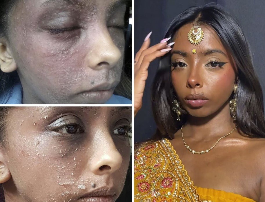 Η Karishma Leckraz χρειάστηκε χρόνια για να καταλάβει τι της συμβαίνει. «Το TSW μου πήρε τα πάντα. Κρύφτηκα από τον κόσμο. Το δέρμα μου ήταν σε τρομερή κατάσταση, δεν κοιμόμουν, δεν αναγνώριζα τον εαυτό μου». Παρότι έχει βελτιωθεί, το ψυχολογικό βάρος παραμένει: «Το κοινωνικό μου άγχος είναι τεράστιο» / FACEBOOK