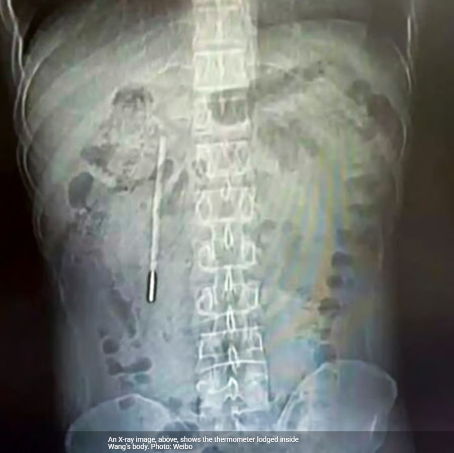 Οι ακτινογραφίες αποκάλυψαν την παρουσία του θερμόμετρου υδραργύρου στο δωδεκαδάκτυλο