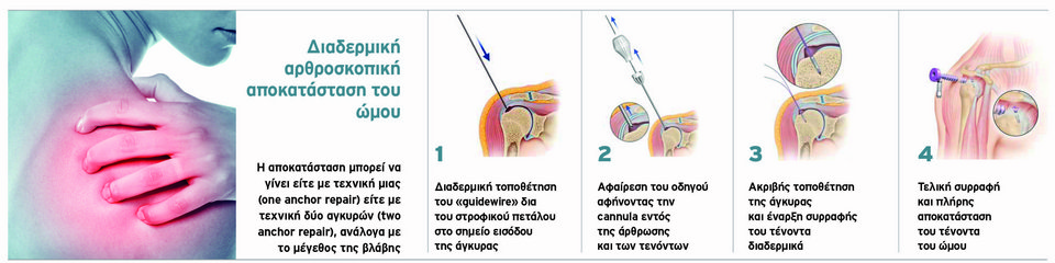 Η πρωτοποριακή θεραπεία του Metropolitan Hospital με διαδερμική αρθροσκοπική αποκατάσταση του ώμου