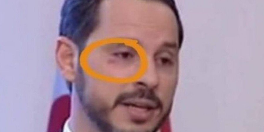 Η φωτογραφία του Μπεράτ Αλμπαϊράκ με το μαυρισμένο μάτι έδωσε τροφή στις φήμες για ξυλοδαρμό του ως αντίποινα για εξωσυζυγικό παραστράτημα.