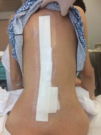 Νεαρή 27 ετών με σκολίωση, η οποία αντιμετωπίστηκε με ρομποτική χειρουργική από τον Δρ. Λυκίσσα. Εικόνα πριν και εικόνα 24 ώρες μετά το χειρουργείο