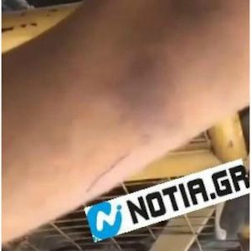 Σημάδια στα χέρια ανθρώπων που πρωταγωνίστησαν στα επεισόδια / Φωτογραφία: notia.gr