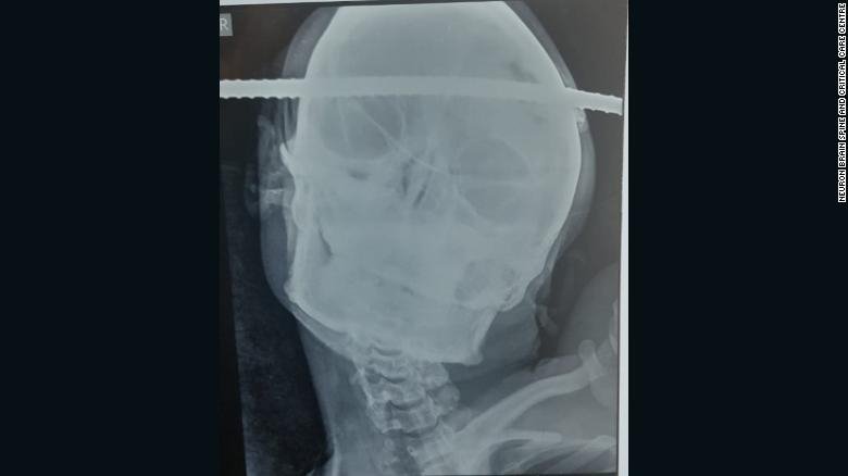 Ακτινογραφία που δείχνει λοστό να έχει τρυπήσει το κρανίο άνδρα