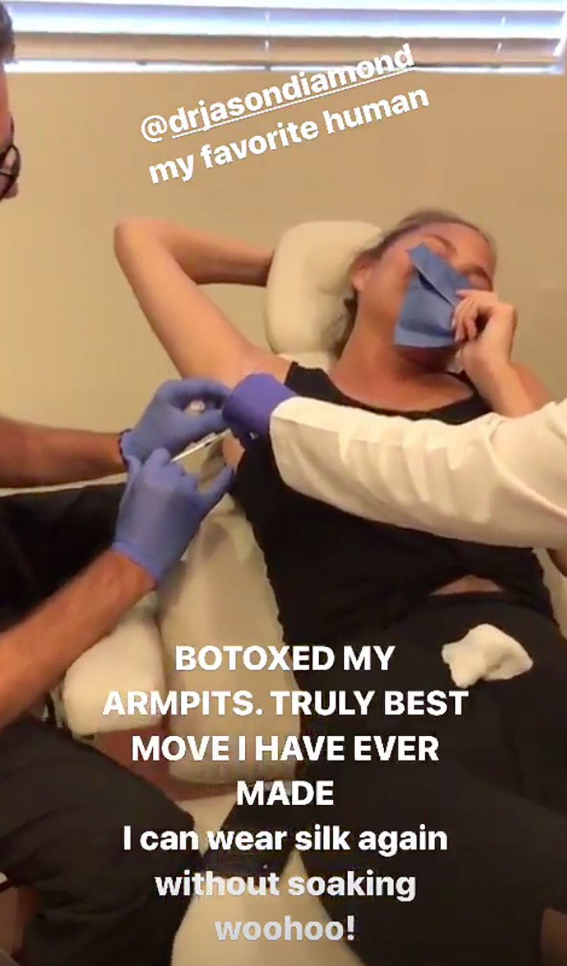 Η Κρίσι Τέιγκεν κάνει botox στις μασχάλες