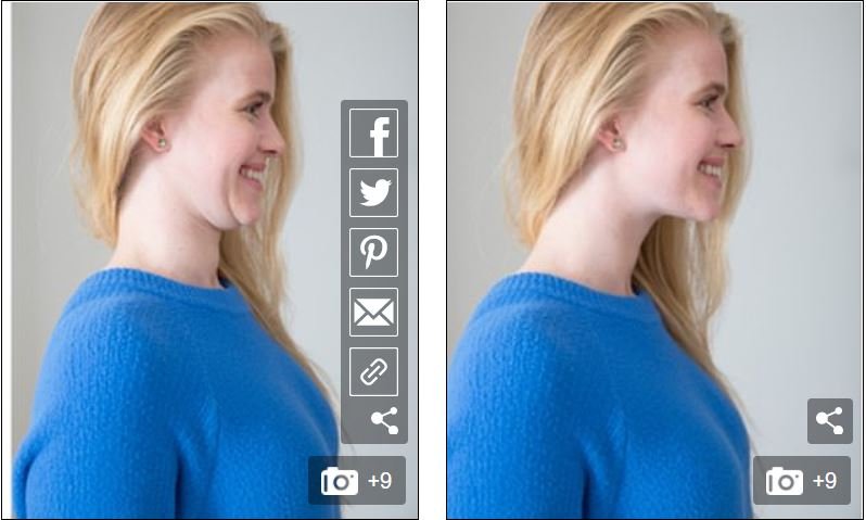 κόλπο για διπλοσάγονο πριν και μετά φωτογραφίες