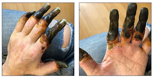 Η κυκλοφορία του αίματος δεν έφτανε στα χέρια και τα δάχτυλά του και έγιναν μαύρα