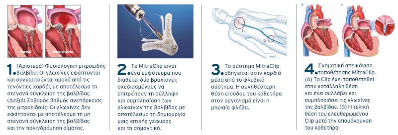 Η τεχνική MitraClip