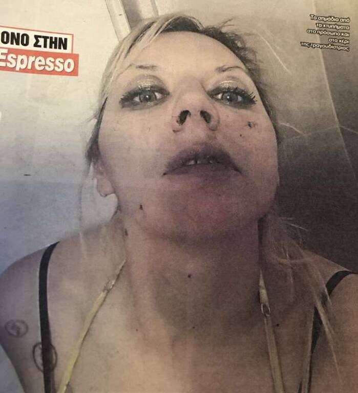 Η φωτογραφία που δείχνει τα σημάδια της επίθεσης στην τραγουδίστρια/Φωτογραφία: Espresso