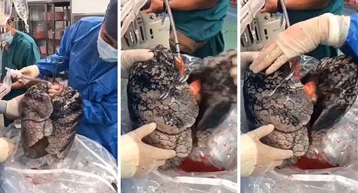 Το φυσιολογικό χρώμα των πνευμόνων του ανθρώπου είναι ένα απαλό ροζ