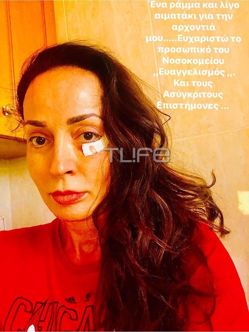 Η Βίκυ Σταμάτη με τραύμα στο μάτι