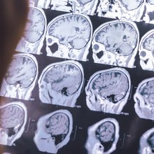 εξετάσεις εγκεφάλου