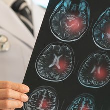 Εγκεφαλικό