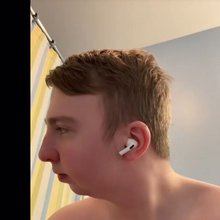 Πριν την διπλή επέμβαση γνάθου