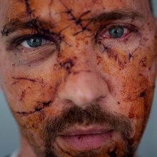 Βαριά τραυματίας του πολέμου στην Ουκρανία