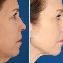 Πριν και μετά το λίφτινγκ