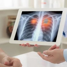 Καρκίνος του πνεύμονα