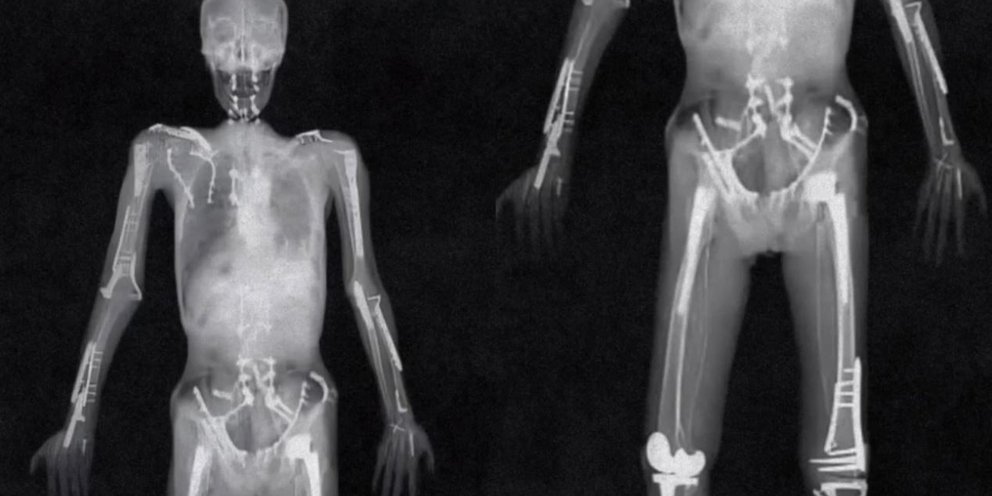 Σοκάρει η ακτινογραφία αθλητή