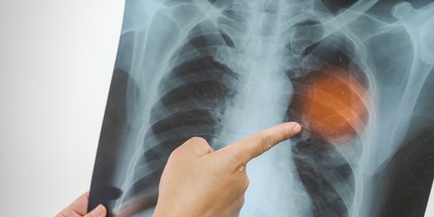 αποτυπωση φυματιωσης