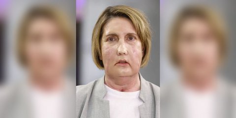 Γιατροί στην Ισπανία έγραψαν ιστορία: Η πρώτη μεταμόσχευση προσώπου με δότρια που υποβλήθηκε σε υποβοηθούμενη ευθανασία