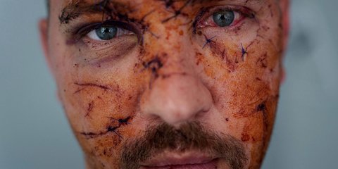 Βαριά τραυματίας του πολέμου στην Ουκρανία