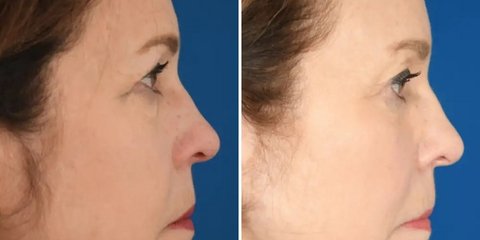 Πριν και μετά το λίφτινγκ