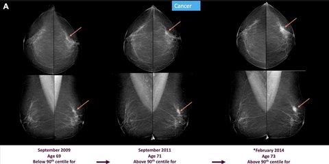 CREDIT: Radiological Society of North America (RSNA)
