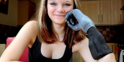 Χάρη στο βιονικό χέρι της μπορεί πλέον να χειρίζεται αντικείμενα