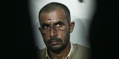 Ελλάδα, 2017: Ο μετανάστης από το Πακιστάν, με τα σημάδια της άγριας επίθεσης που δέχτηκε-Φωτογραφία: Nikos Libertas / SOOC