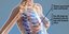 Σουτιέν κάτω από το δέρμα -Πρωτοποριακή μέθοδος ανόρθωσης στήθους που λειτουργεί