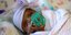Το μικρότερο νεογέννητο στον κόσμο, ζύγιζε μόλις 246 γραμμάρια