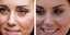 Η Κέιτ Μίντλετον πριν και μετά το botox