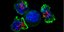 Ομάδα T κυττάρων περιβάλλουν καρκινικό κύτταρο (μπλε χρώμα)