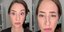 Έκανε botox στο μισό πρόσωπό της και έδειξε τα αποτελέσματα