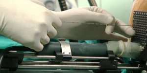 Επαναστατική μέθοδος θεραπείας του καρκίνου του προστάτη με... υπερήχους!