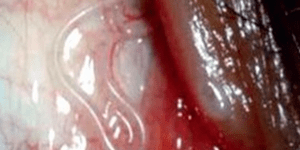 Σοκ: Ζούσε με ένα τεράστιο σκουλήκι μέσα στο μάτι του! [εικόνες]