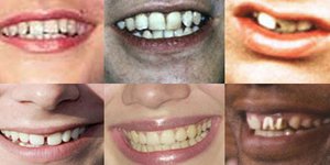 Διάσημα χαμόγελα πριν και μετά [εικόνες]