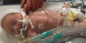 Και όμως ζει – Γεννήθηκε με την καρδιά στην δεξιά πλευρά!
