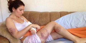 Φωτογραφίες σοκ: Τούρκοι αστυνομικοί έσπασαν το χέρι και το πόδι φοιτήτριας σε δ