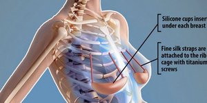 Σουτιέν κάτω από το δέρμα -Πρωτοποριακή μέθοδος ανόρθωσης στήθους που λειτουργεί