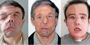 Ο Ζερόμ Αμόν υποβλήθηκε σε δύο μεταμοσχεύσεις προσώπου (Φωτογραφία: ΑΡ) 