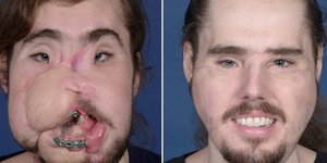 O Κάμερον Άντεργουντ πριν και μετά την επέμβαση μεταμόσχευσης προσώπου (Φωτογραφία: NYU Langone Health)