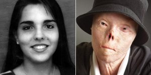 Η Τζάκελιν Σαμπουρίντο υπέστη φρικτά εγκαύματα σε ηλικία 20 ετών 